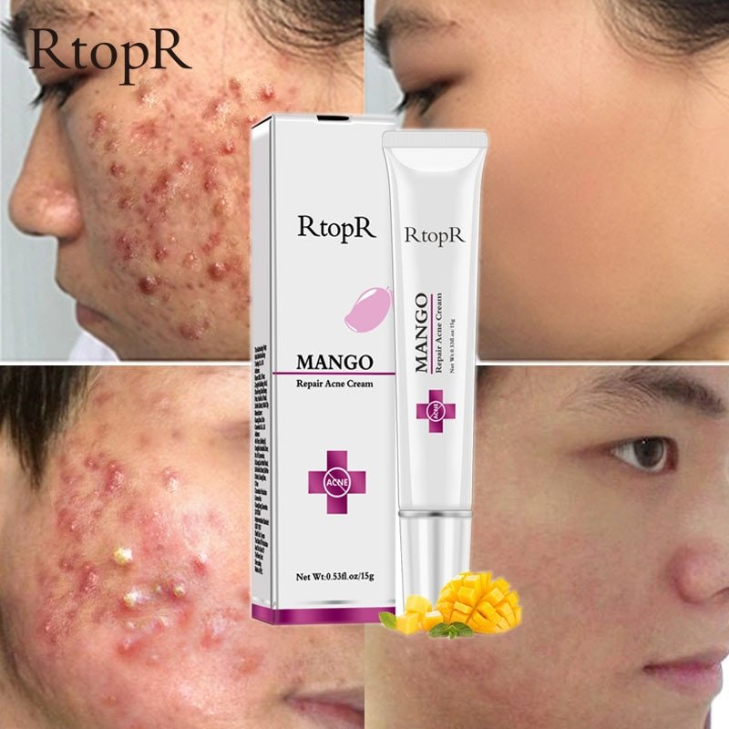 Acne Behandeling Gezicht Crème Mee-eter Reparatie Gel Olie Controle Krimpen Poriën Litteken Whitening Moisturizer Huidverzorging Koreaanse Cosmetica