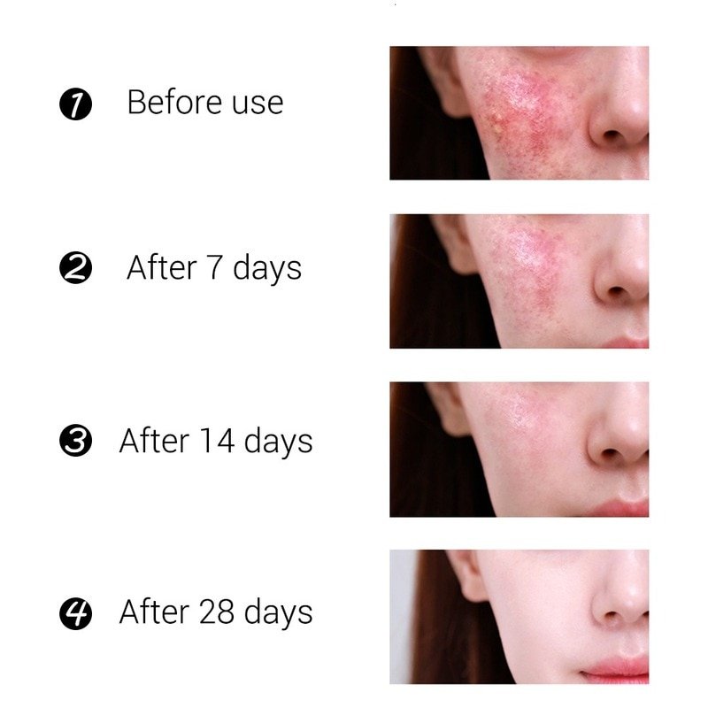 Acne Behandeling Gezicht Crème Mee-eter Reparatie Gel Olie Controle Krimpen Poriën Litteken Whitening Moisturizer Huidverzorging Koreaanse Cosmetica