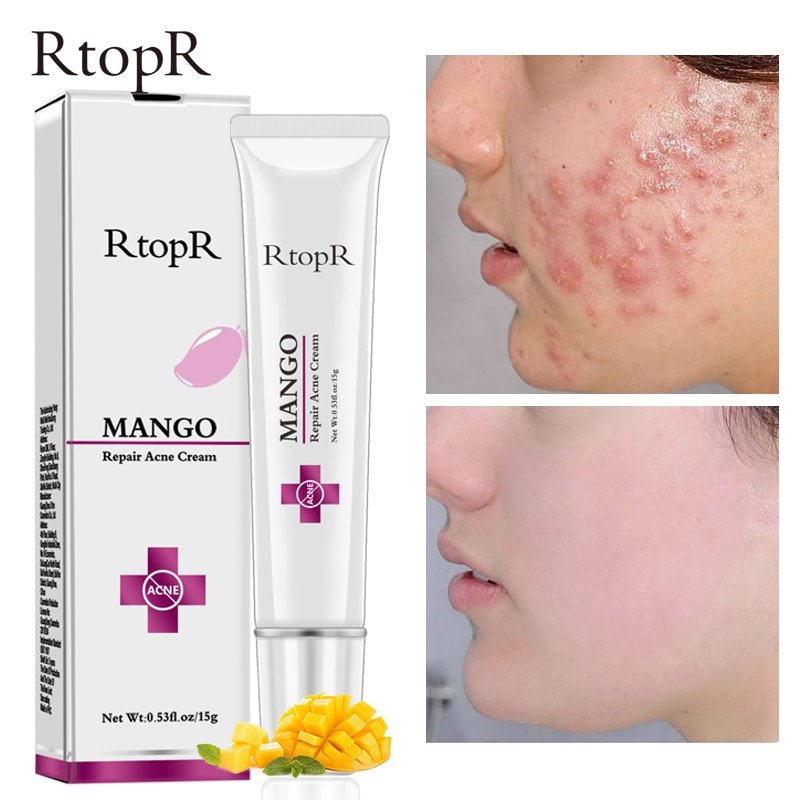 Acne Behandeling Gezicht Crème Mee-eter Reparatie Gel Olie Controle Krimpen Poriën Litteken Whitening Moisturizer Huidverzorging Koreaanse Cosmetica