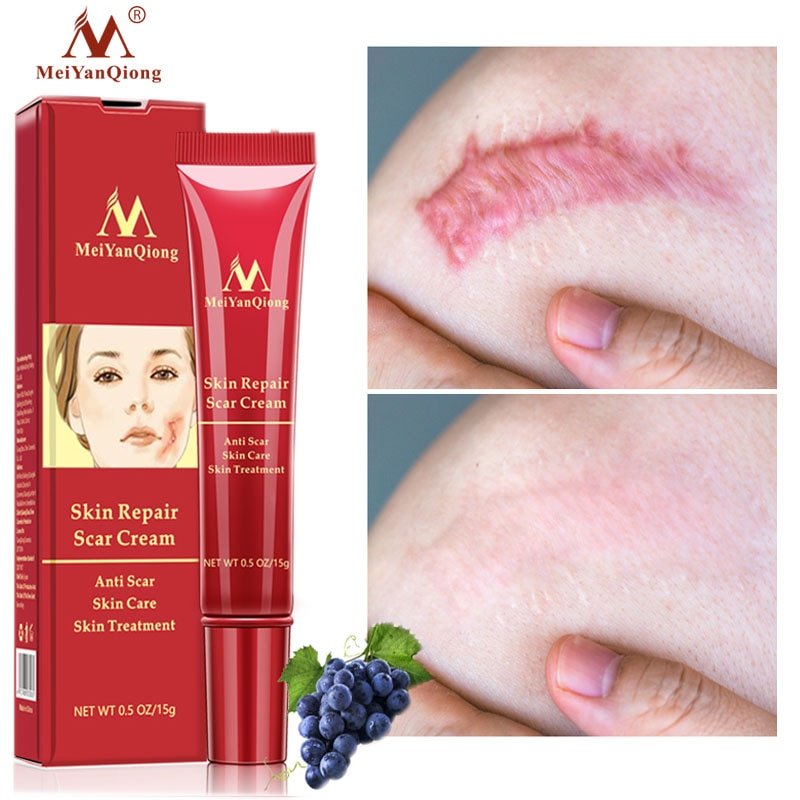 Acne Litteken Verwijdering Gezicht Crème Acne Vlekken Acne Pigmentatie Corrector Whitening Cream Anti Litteken Striae Reparatie Huidverzorging