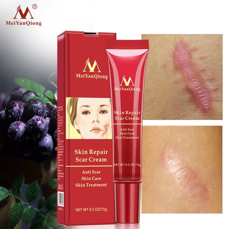 Acne Litteken Verwijdering Gezicht Crème Acne Vlekken Acne Pigmentatie Corrector Whitening Cream Anti Litteken Striae Reparatie Huidverzorging