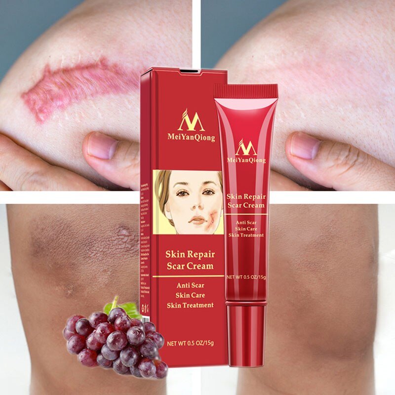 Acne Litteken Verwijdering Gezicht Crème Acne Vlekken Acne Pigmentatie Corrector Whitening Cream Anti Litteken Striae Reparatie Huidverzorging
