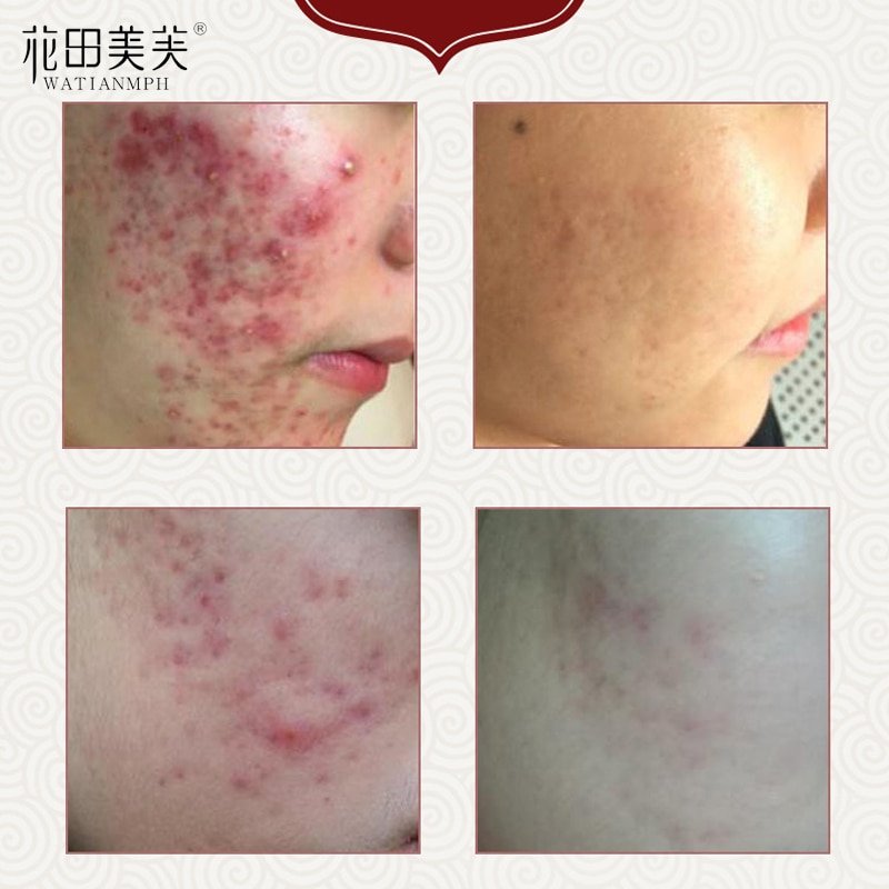 Acne Litteken Verwijdering Crème Voor Oude Litteken Keizersnede Littekens Chirurgische Littekens Burn Littekens Lichaamsverzorging Kruiden Crème Kids & Volwassenen 30G