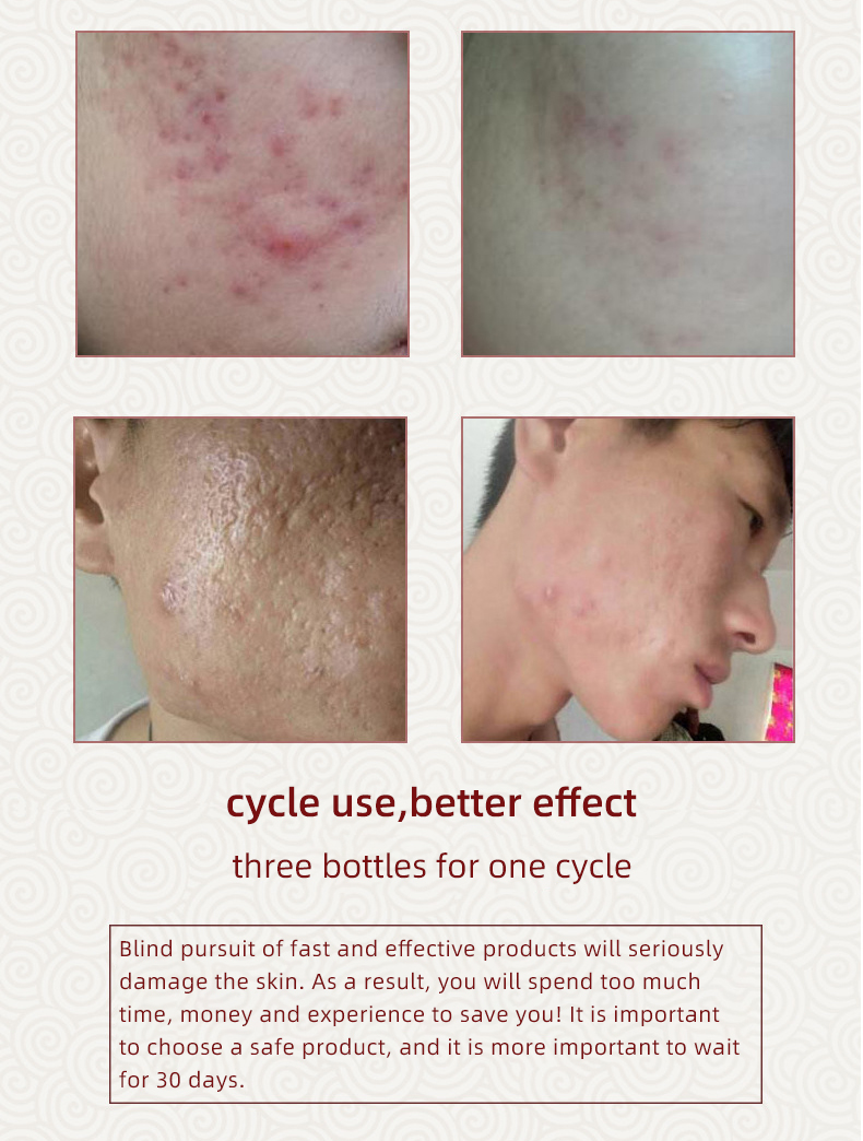 Acne Litteken Verwijdering Crème Voor Oude Litteken Keizersnede Littekens Chirurgische Littekens Burn Littekens Lichaamsverzorging Kruiden Crème Kids & Volwassenen 30G Acne Litteken Verwijdering Crème Voor Oude Litteken Keizersnede Littekens Chirurgische Littekens Burn Littekens Lichaamsverzorging Kruiden Crème Kids & Volwassenen 30G