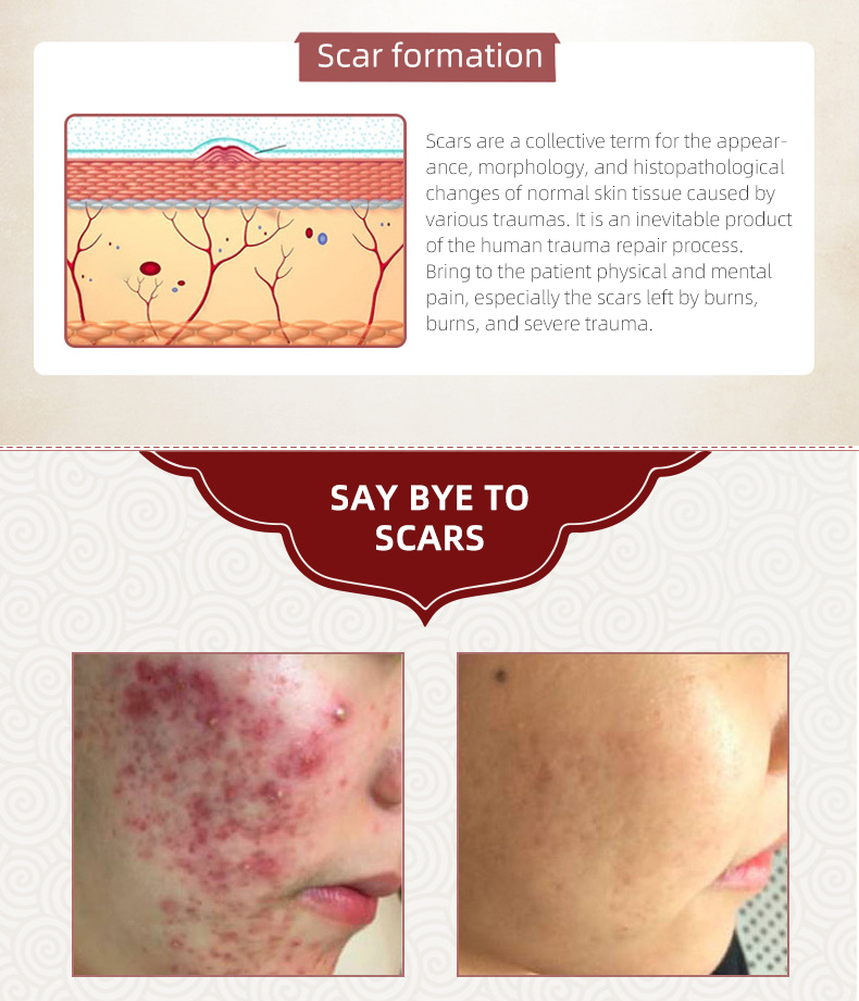 Acne Litteken Verwijdering Crème Voor Oude Litteken Keizersnede Littekens Chirurgische Littekens Burn Littekens Lichaamsverzorging Kruiden Crème Kids & Volwassenen 30G Acne Litteken Verwijdering Crème Voor Oude Litteken Keizersnede Littekens Chirurgische Littekens Burn Littekens Lichaamsverzorging Kruiden Crème Kids & Volwassenen 30G