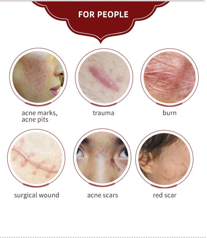 Acne Litteken Verwijdering Crème Voor Oude Litteken Keizersnede Littekens Chirurgische Littekens Burn Littekens Lichaamsverzorging Kruiden Crème Kids & Volwassenen 30G