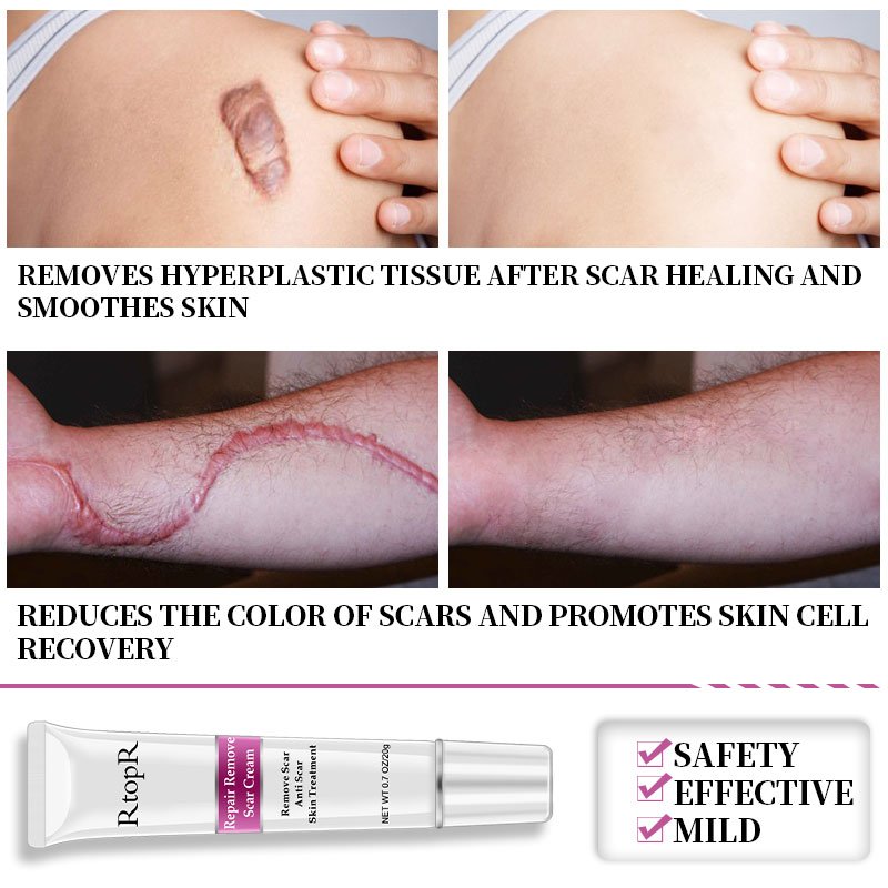 Rtopr Acne Litteken Striae Remover Crème Huid Reparatie Gezichtscrème Acne Vlekken Acne Behandeling Mee-eter Whitening Cream Huidverzorging