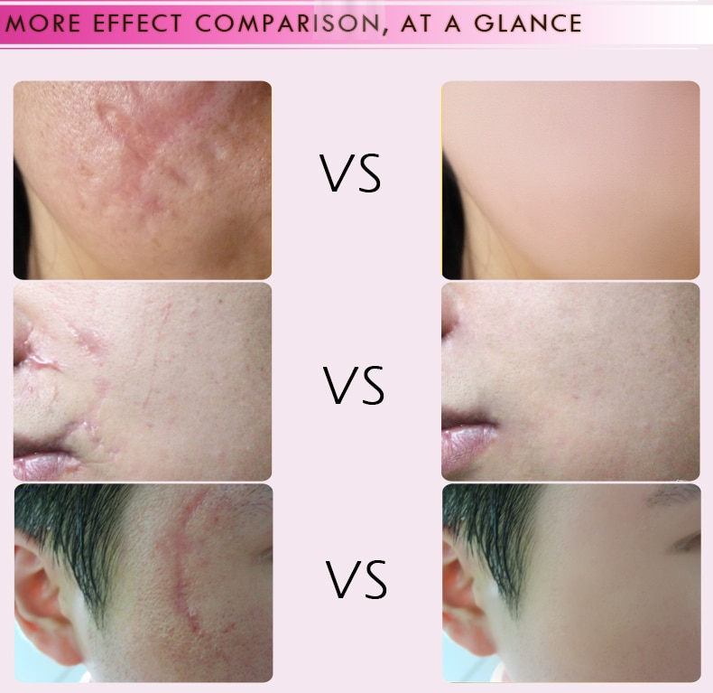 Rtopr Acne Litteken Striae Remover Crème Huid Reparatie Gezichtscrème Acne Vlekken Acne Behandeling Mee-eter Whitening Cream Huidverzorging Rtopr Acne Litteken Striae Remover Crème Huid Reparatie Gezichtscrème Acne Vlekken Acne Behandeling Mee-eter Whitening Cream Huidverzorging