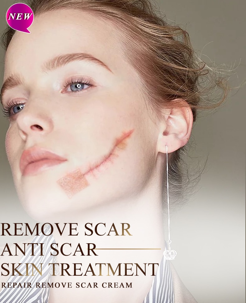 Rtopr Acne Litteken Striae Remover Crème Huid Reparatie Gezichtscrème Acne Vlekken Acne Behandeling Mee-eter Whitening Cream Huidverzorging Rtopr Acne Litteken Striae Remover Crème Huid Reparatie Gezichtscrème Acne Vlekken Acne Behandeling Mee-eter Whitening Cream Huidverzorging
