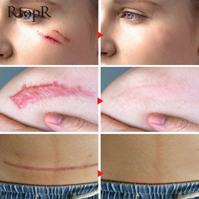 Rtopr Acne Litteken Striae Remover Crème Huid Reparatie Gezichtscrème Acne Vlekken Acne Behandeling Mee-eter Whitening Cream Huidverzorging