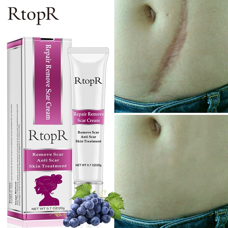 Rtopr Acne Litteken Striae Remover Crème Huid Reparatie Gezichtscrème Acne Vlekken Acne Behandeling Mee-eter Whitening Cream Huidverzorging