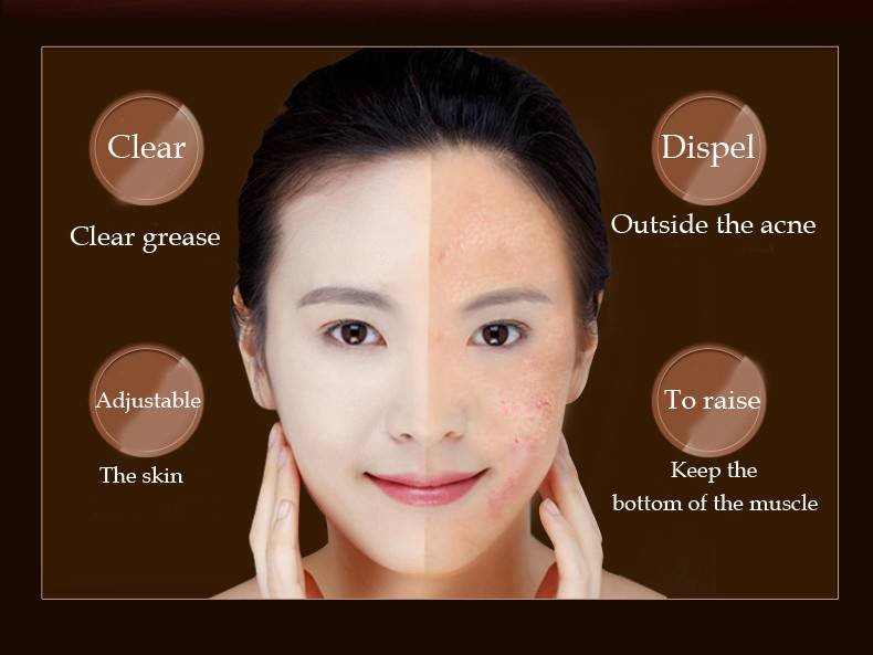 Herbal Acne Cream with CBD Oil