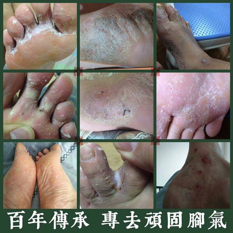 2Pcs/1Lot Anti Fungal Infections Foot Cream For Athlete’s Foot Treating Beriberi Itch Erosion Peeling Blisters Feet Ointmen 2Pcs/1Lot Anti Fungal Infections Foot Cream For Athlete's Foot Treating Beriberi Itch Erosion Peeling Blisters Feet Ointmen