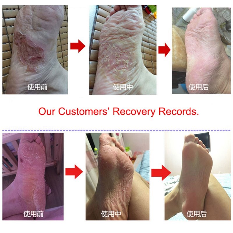 2Pcs/1Lot Anti Fungal Infections Foot Cream For Athlete’s Foot Treating Beriberi Itch Erosion Peeling Blisters Feet Ointmen 2Pcs/1Lot Anti Fungal Infections Foot Cream For Athlete's Foot Treating Beriberi Itch Erosion Peeling Blisters Feet Ointmen