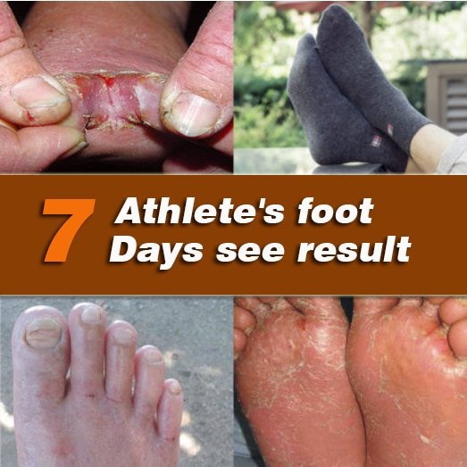2Pcs/1Lot Anti Fungal Infections Foot Cream For Athlete’s Foot Treating Beriberi Itch Erosion Peeling Blisters Feet Ointmen 2Pcs/1Lot Anti Fungal Infections Foot Cream For Athlete's Foot Treating Beriberi Itch Erosion Peeling Blisters Feet Ointmen
