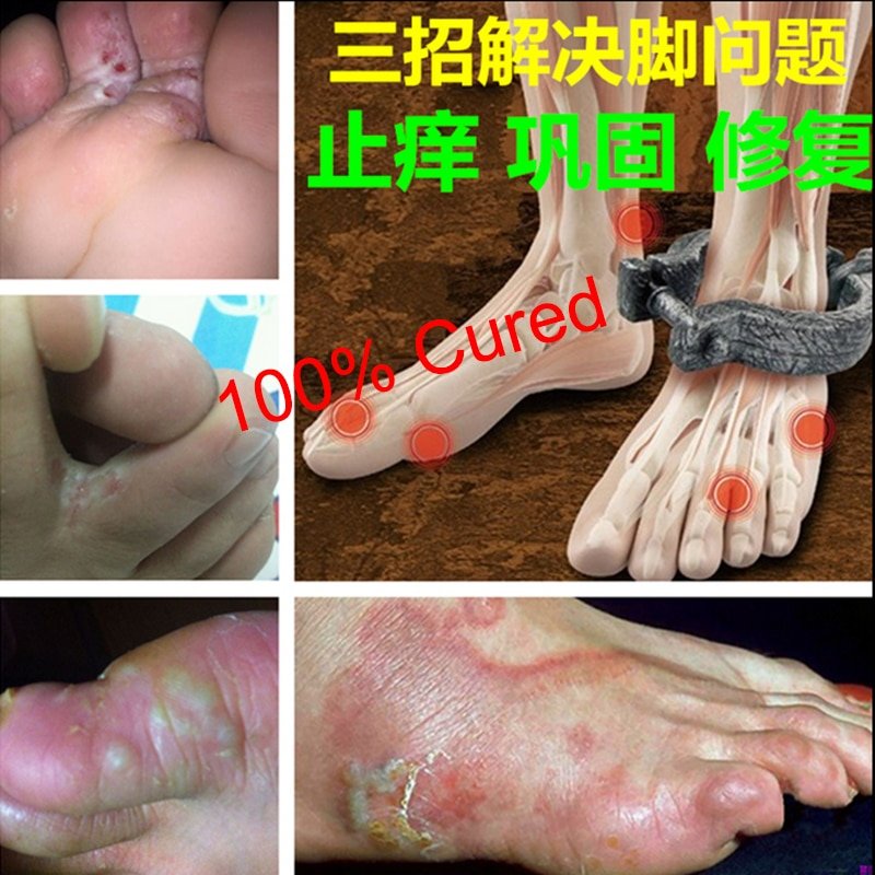 2Pcs/1Lot Anti Fungal Infections Foot Cream For Athlete’s Foot Treating Beriberi Itch Erosion Peeling Blisters Feet Ointmen 2Pcs/1Lot Anti Fungal Infections Foot Cream For Athlete's Foot Treating Beriberi Itch Erosion Peeling Blisters Feet Ointmen