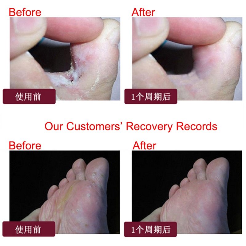 2Pcs/1Lot Anti Fungal Infections Foot Cream For Athlete’s Foot Treating Beriberi Itch Erosion Peeling Blisters Feet Ointmen 2Pcs/1Lot Anti Fungal Infections Foot Cream For Athlete's Foot Treating Beriberi Itch Erosion Peeling Blisters Feet Ointmen