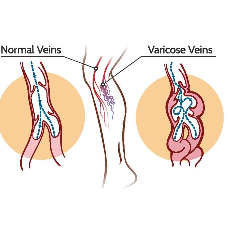 KONGDY Varicose Veins Treatment Cream Varicosity Angiitis Remedy Ointment Relief Veins Pain Phlebitis legs Varicose Veins Cream KONGDY Varicose Veins Treatment Cream Varicosity Angiitis Remedy Ointment Relief Veins Pain Phlebitis legs Varicose Veins Cream