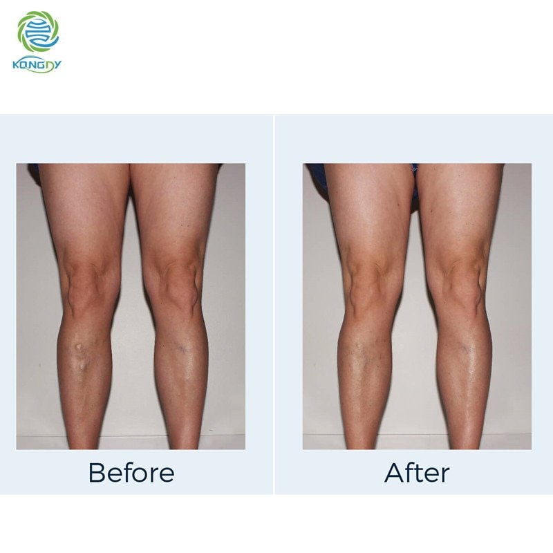 KONGDY Varicose Veins Treatment Cream Varicosity Angiitis Remedy Ointment Relief Veins Pain Phlebitis legs Varicose Veins Cream KONGDY Varicose Veins Treatment Cream Varicosity Angiitis Remedy Ointment Relief Veins Pain Phlebitis legs Varicose Veins Cream