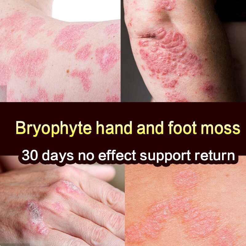 30G Dermatitis Crème Huid Psoriasis Crème Dermatitis Eczematoid Eczeem Zalf Behandeling Psoriasis Crème Gezondheidszorg 30G Dermatitis Crème Huid Psoriasis Crème Dermatitis Eczematoid Eczeem Zalf Behandeling Psoriasis Crème Gezondheidszorg