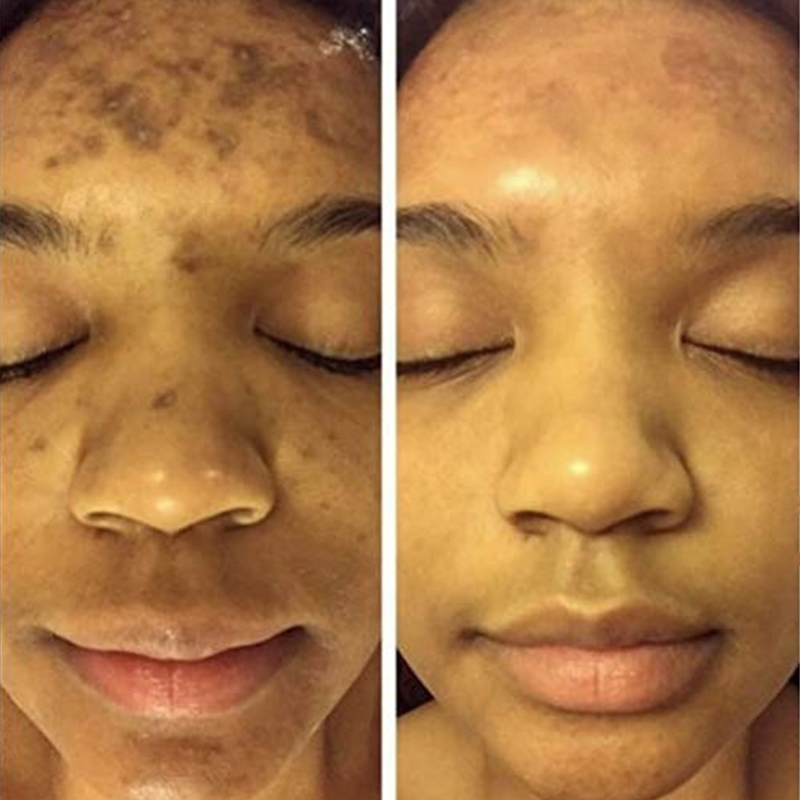 Kurkuma Whitening Sproet Serum Vervagen Donkere Spot Acne Litteken Heldere Gezicht Huid Corrector Curcumine Lichter Melanine Verbeteren Ruwheid Kurkuma Whitening Sproet Serum Vervagen Donkere Spot Acne Litteken Heldere Gezicht Huid Corrector Curcumine Lichter Melanine Verbeteren Ruwheid