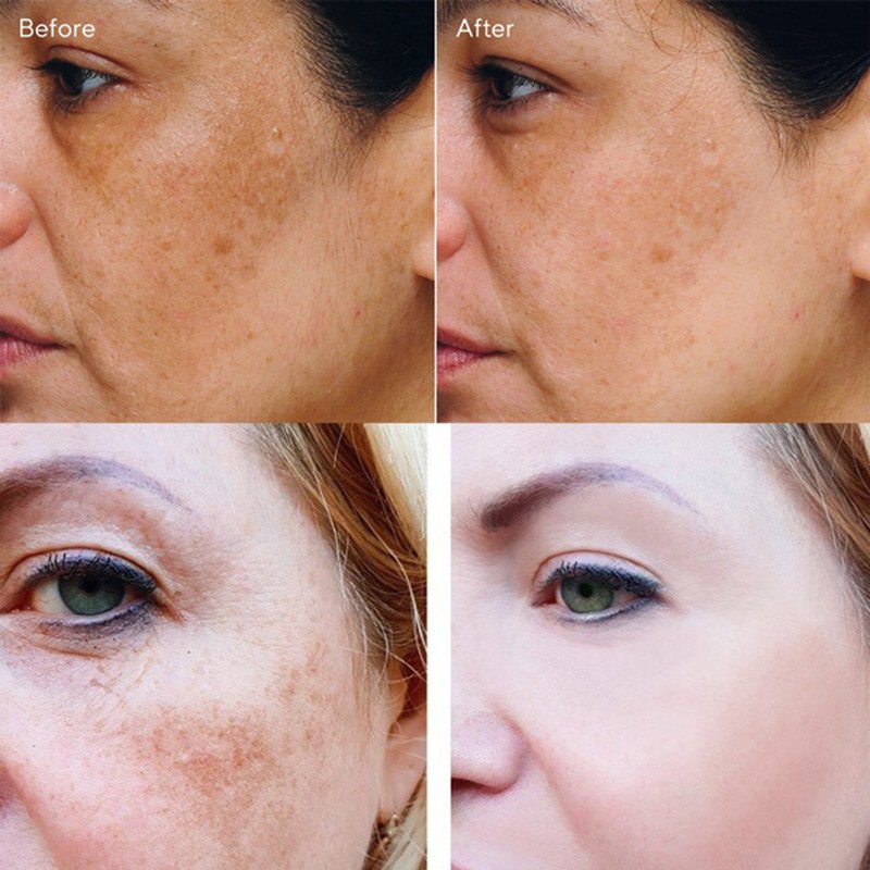 Kurkuma Whitening Sproet Serum Vervagen Donkere Spot Acne Litteken Heldere Gezicht Huid Corrector Curcumine Lichter Melanine Verbeteren Ruwheid Kurkuma Whitening Sproet Serum Vervagen Donkere Spot Acne Litteken Heldere Gezicht Huid Corrector Curcumine Lichter Melanine Verbeteren Ruwheid