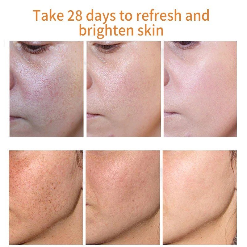 Kurkuma Sproet Whitening Serum Curcumine Olie Fleuren Vervagen Donkere Vlek Verwijdering Pigment Melanine Corrigeren Schoonheid Gezicht Huidverzorging