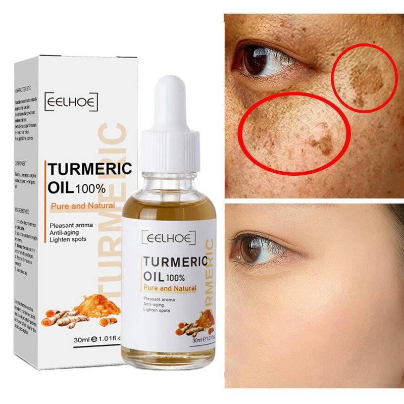 Kurkuma Sproet Whitening Serum Curcumine Olie Fleuren Vervagen Donkere Vlek Verwijdering Pigment Melanine Corrigeren Schoonheid Gezicht Huidverzorging