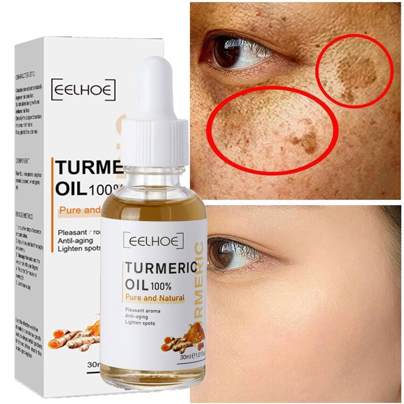 Kurkuma sproet whitening serum curcumine olie fleuren fade dark spot verwijdering pigment melanine corrigeert schoonheid gezicht huidverzorging