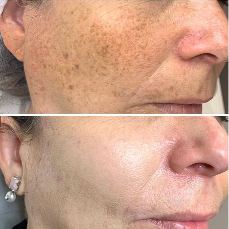 Kurkuma sproet whitening serum curcumine olie fleuren fade dark spot verwijdering pigment melanine corrigeert schoonheid gezicht huidverzorging