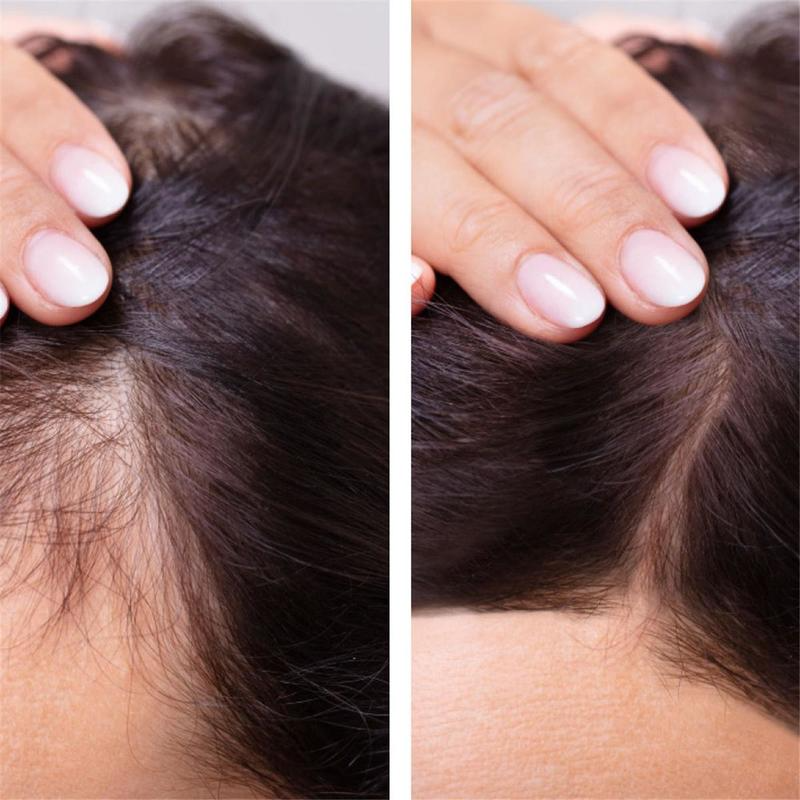 5Ml/15Ml/30Ml/50Ml Haargroei Serum Anti Voorkomen Haaruitval Alopecia Vloeibare beschadigd Haar Reparatie Groeit Sneller